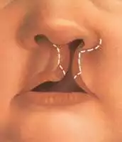 ما هي خطوات عملية إصلاح شق الحنك