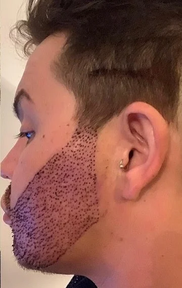 ( زراعة شعر الوجه في ايران (زراعة اللحية