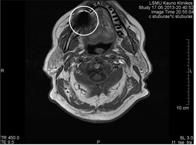 artifact-caused-by-dental-crown