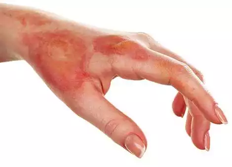 عمليات تجميل الحروق أو جراحة الحروق الترميمية في ايران بمدن شيراز وطهران