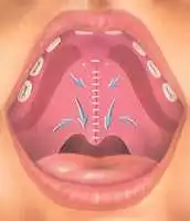 Cleftlip Palate Repair in Mashhad