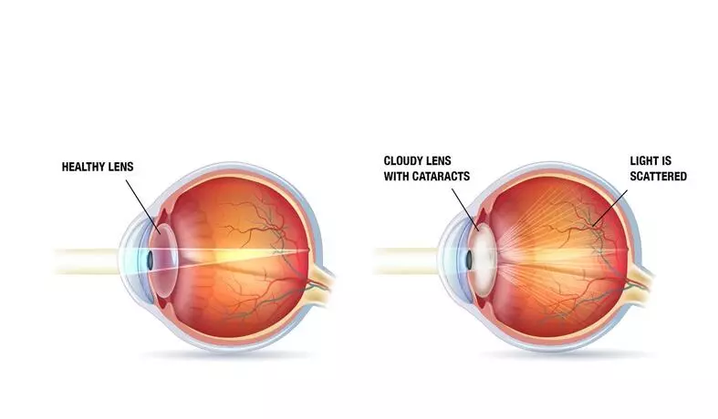 CATARACT SURGERY in iran