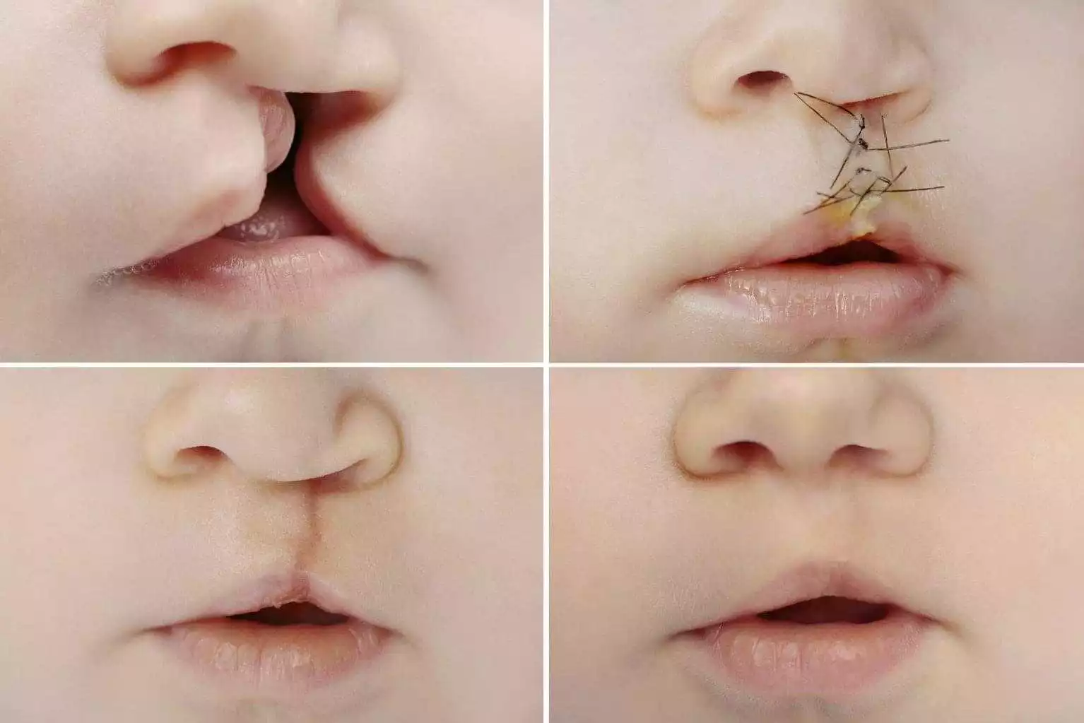 Cleftlip Palate Repair in Iran
