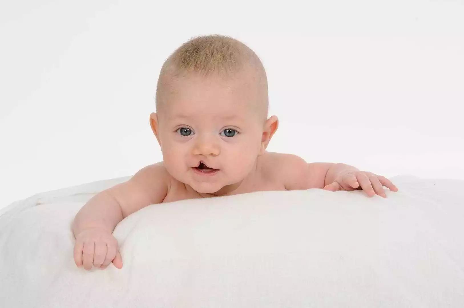 Cleftlip Palate Repair in Iran