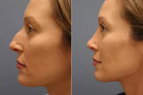 Rhinoplasty in Iran