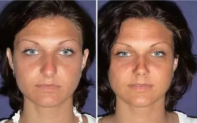 Correct nasal tip asymmetry