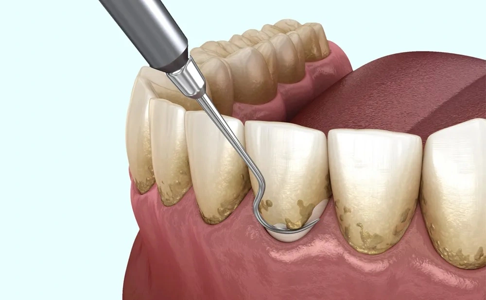 Dental Scaling and Root Planing IN IRAN