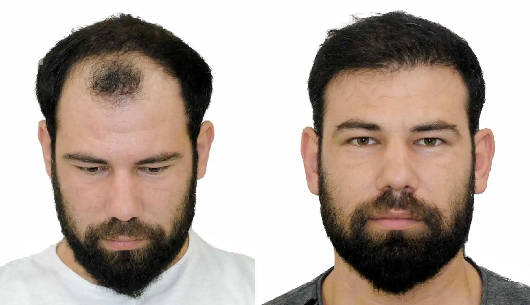 Hair transplant in Shiraz