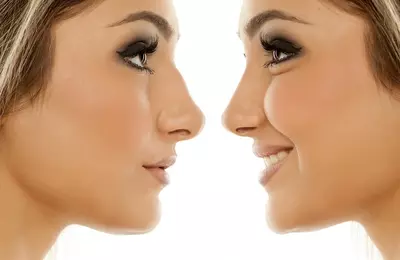Rhinoplasty (nose Job) in Iran