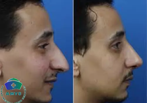 Rhinoplasty in Iran