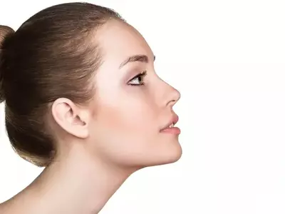 REVISION RHINOPLASTY in iran