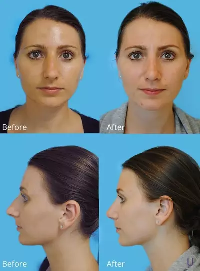 Reduce excessive nasal tip projection in iran