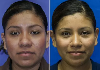 Reduce width of the nose 