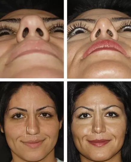 Refine or reduce a bulbous nasal tip 
