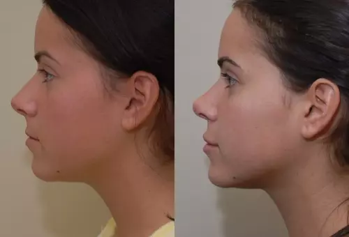 Rhinoplasty in Iran