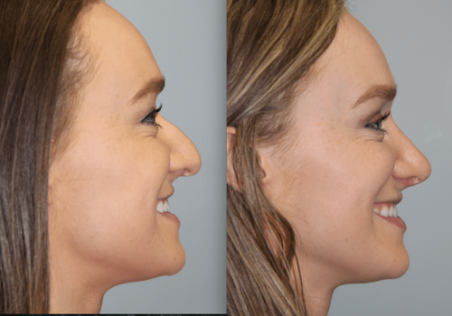 Rhinoplasty in Iran