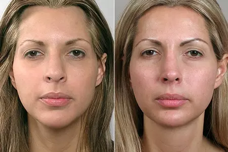 Secondary rhinoplasty in Iran