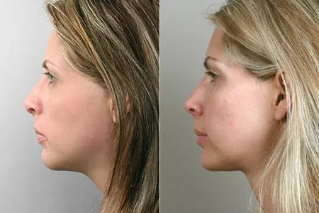 Revise poor nose job results in Iran
