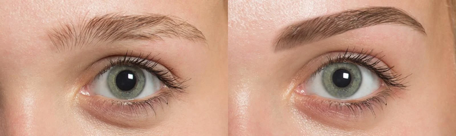 EYEBROW TRANSPLANT IN IRAN