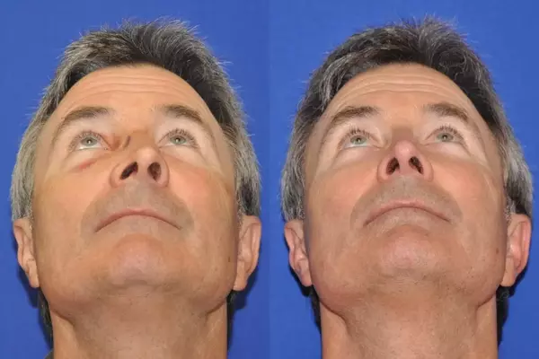 Rhinoplasty in Iran