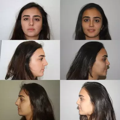 Straighten a crooked nose