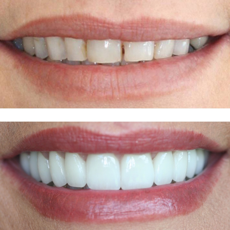Dental Venner in iran shiraz city