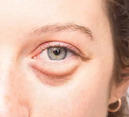 Eyelid Surgery In Iran