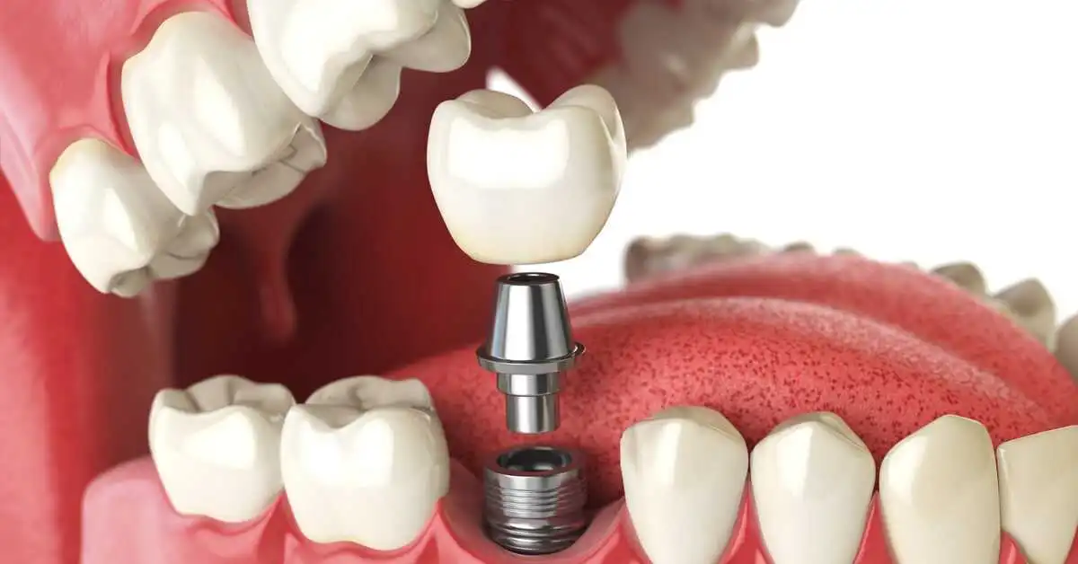  first stage dental implants in iran