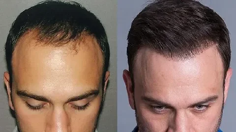 Hair transplant in Shiraz