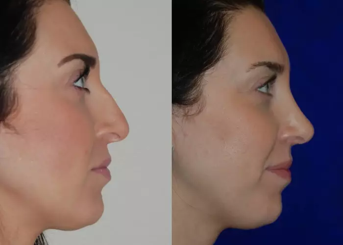 Rhinoplasty in Iran