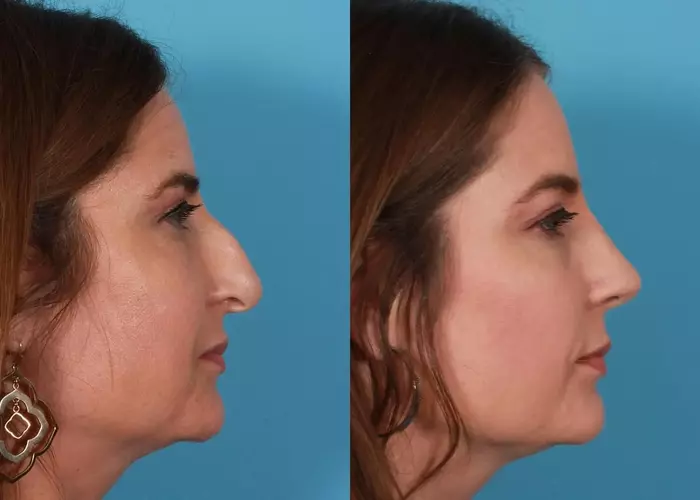 Rhinoplasty in Iran