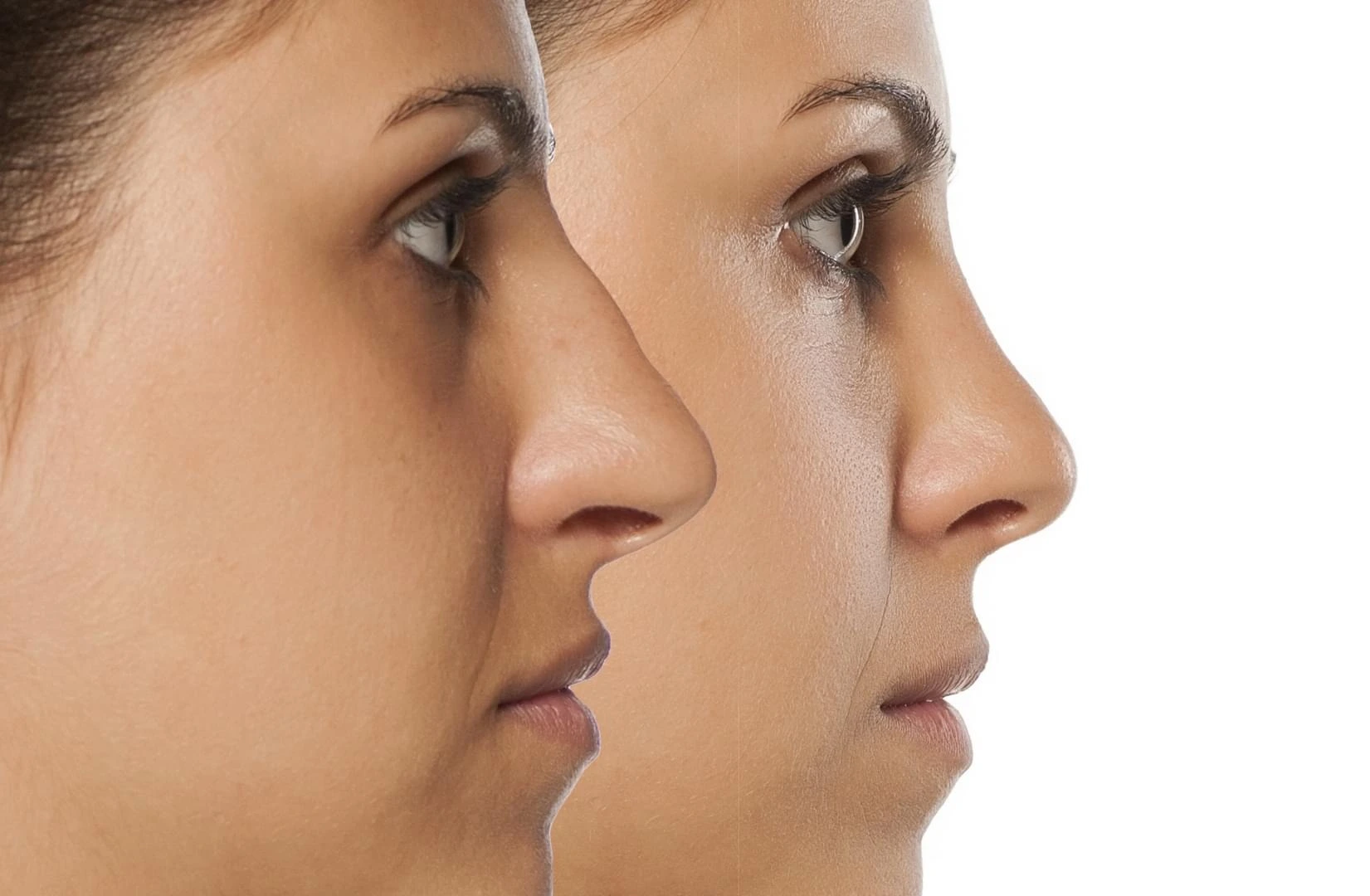 Rhinoplasty in Iran